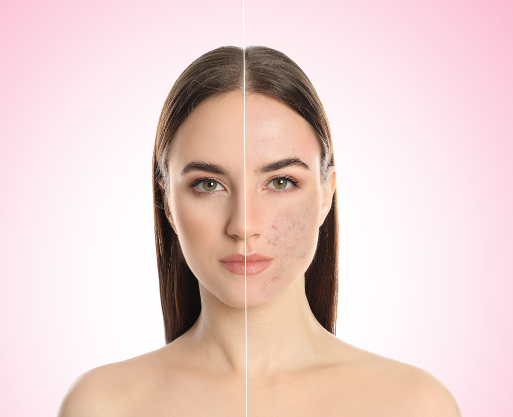 A split-screen comparison of a woman's face showing clear skin improvement with IPL.