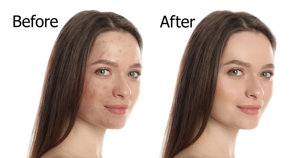 Before and after chemical peels showing a clear and smooth skin transformation.