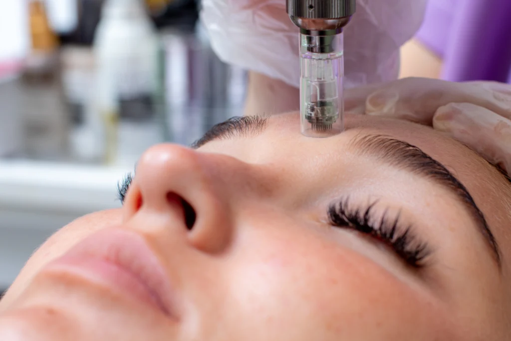 Close-up of a microneedling session on a woman's forehead,