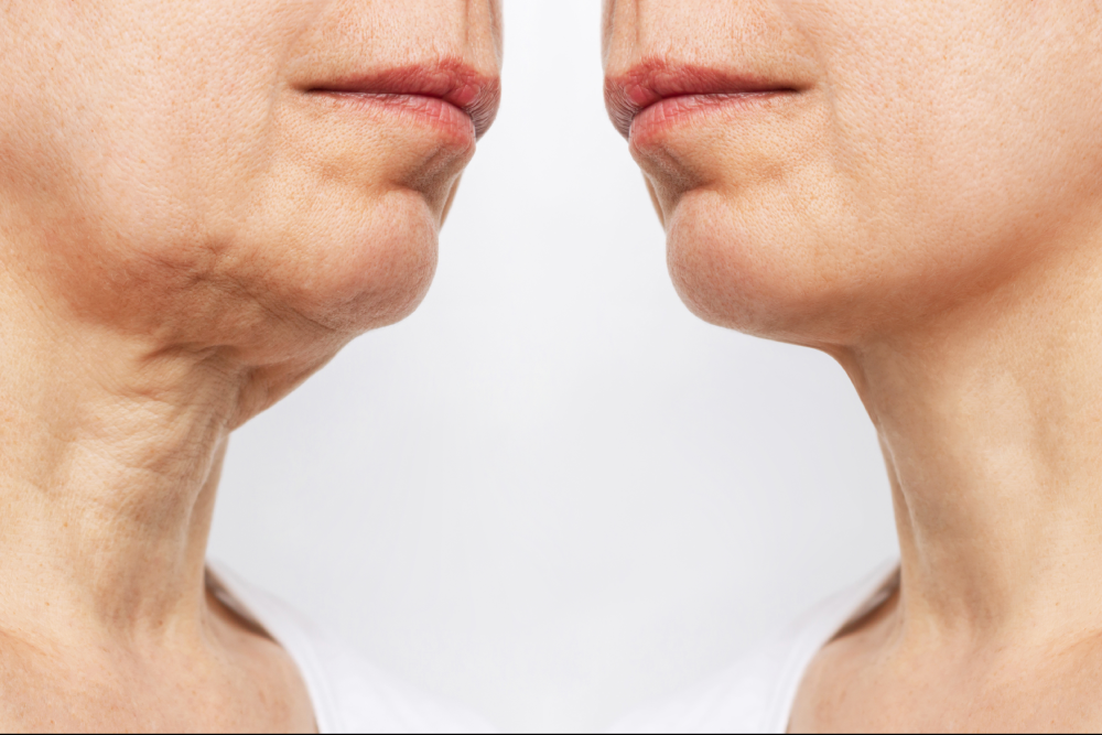 Before and after results of dermal fillers injectables on lower face.