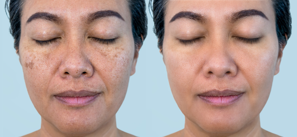 Before and after results of exosome therapy for facial rejuvenation
